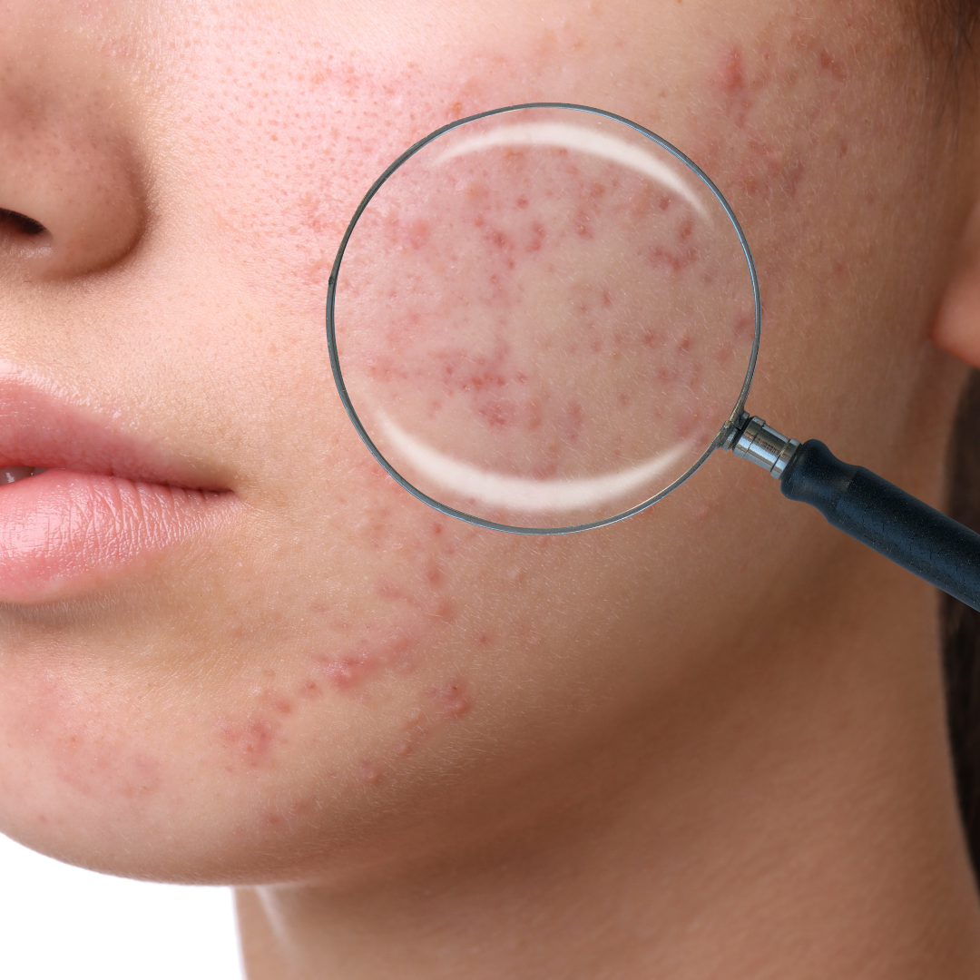 acne with Morgellons Microsopic