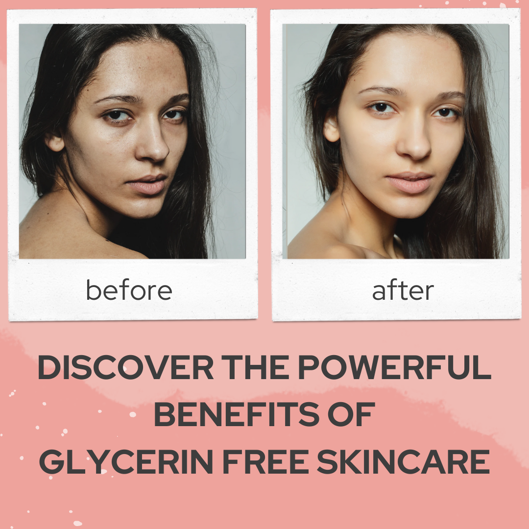 Glycerin-free skincare products designed to treat fungal acne and prevent breakouts.